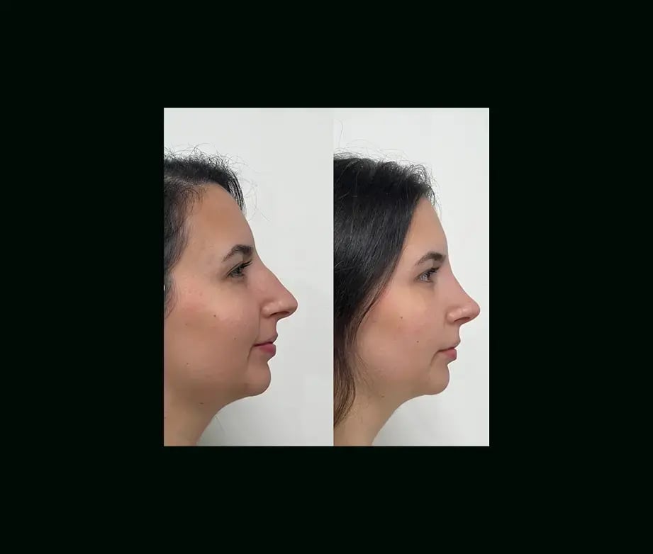 tayfun-demirel-md-rhinoplasty-before-after-13