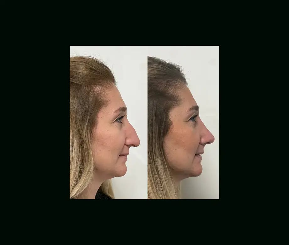 tayfun-demirel-md-rhinoplasty-before-after-14