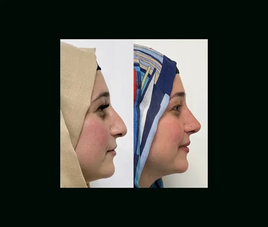 tayfun-demirel-md-rhinoplasty-before-after-15