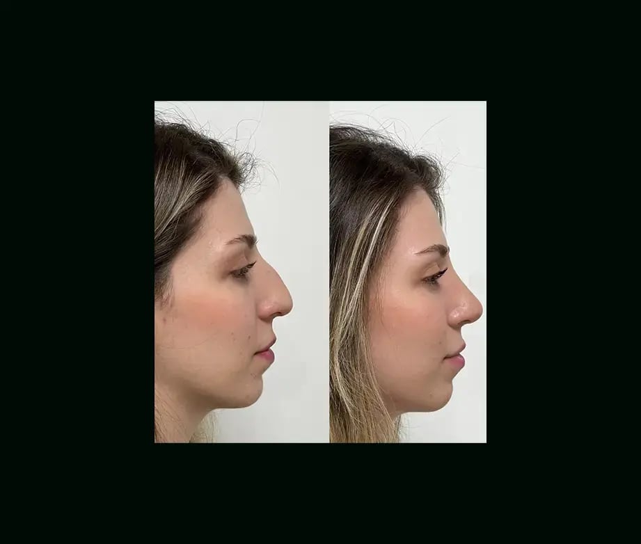tayfun-demirel-md-rhinoplasty-before-after-16