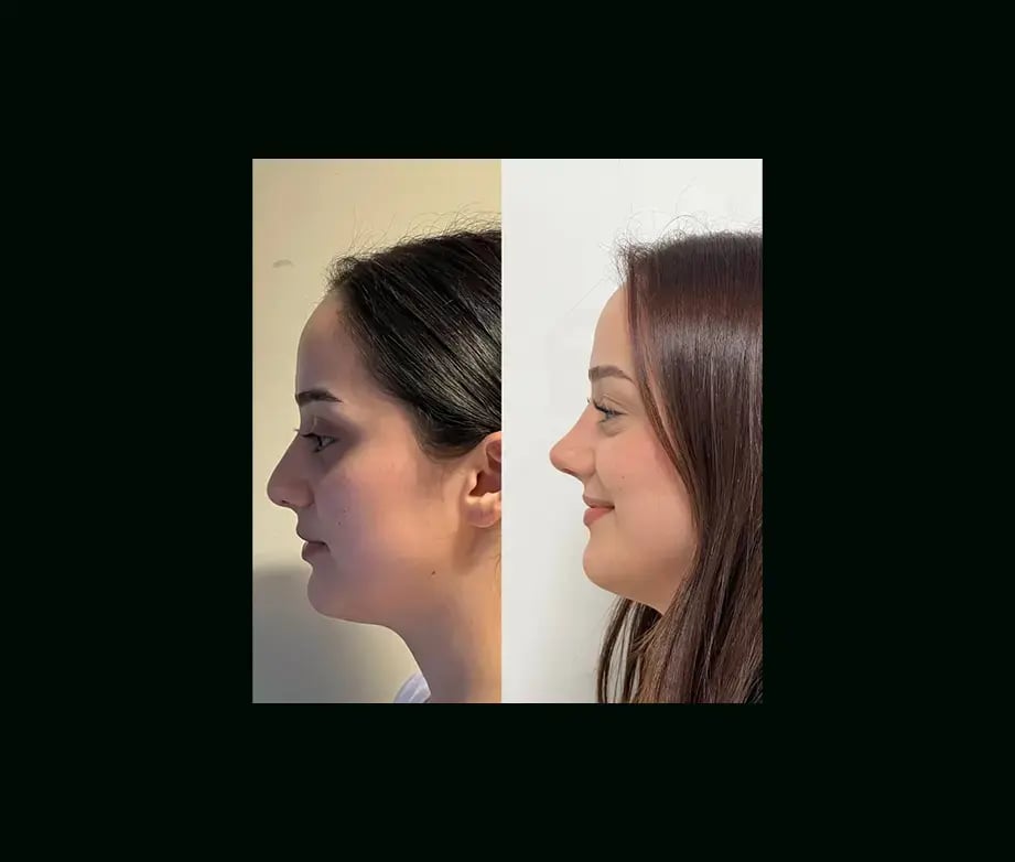 tayfun-demirel-md-rhinoplasty-before-after-17