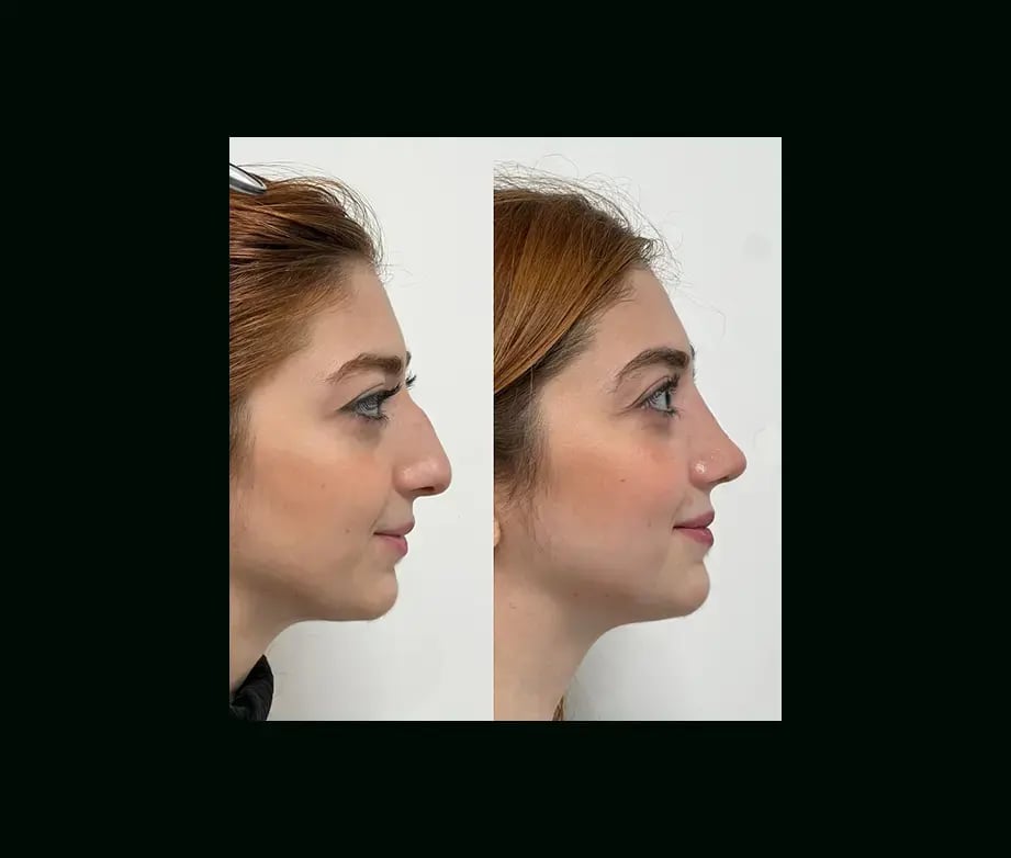 tayfun-demirel-md-rhinoplasty-before-after-18