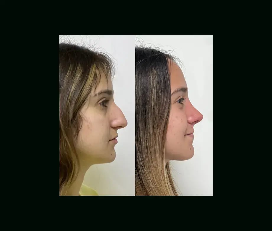 tayfun-demirel-md-rhinoplasty-before-after-19