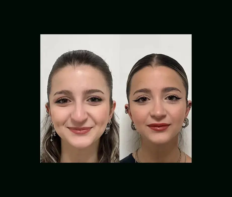 tayfun-demirel-md-rhinoplasty-before-after-2-1