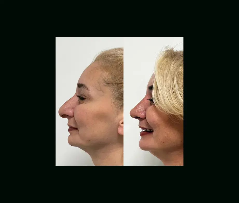 tayfun-demirel-md-rhinoplasty-before-after-20