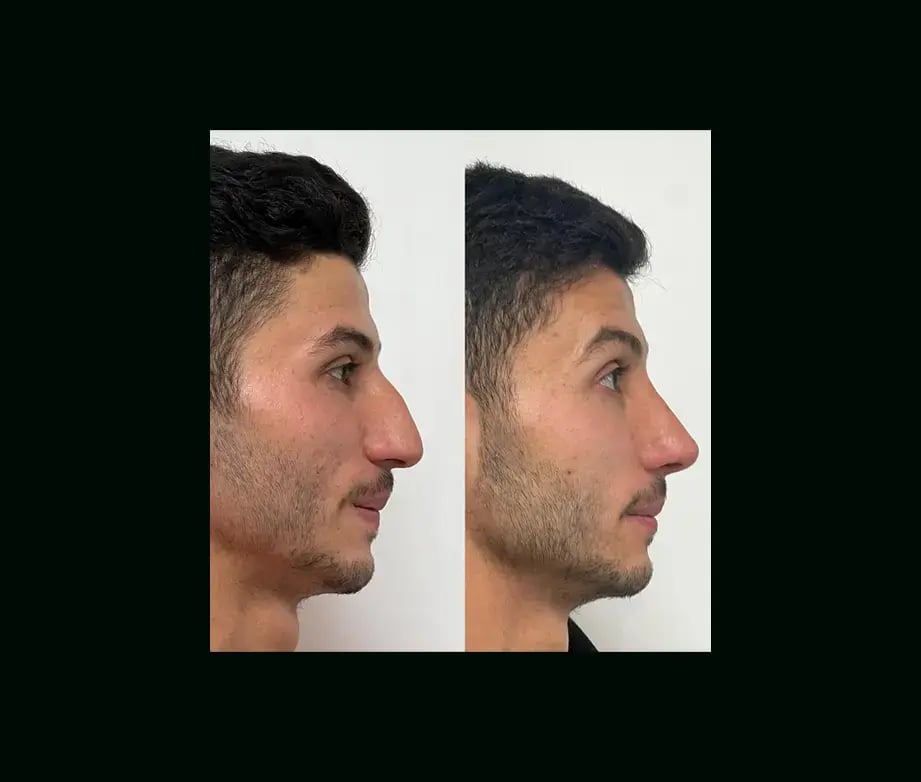tayfun-demirel-md-rhinoplasty-before-after-21