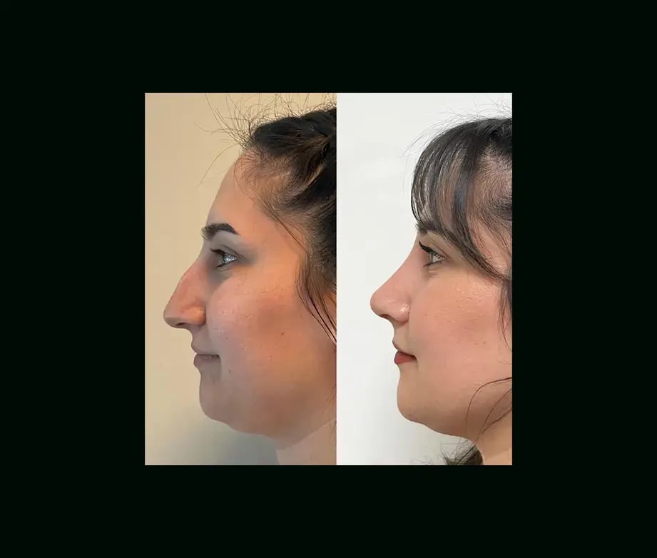 tayfun-demirel-md-rhinoplasty-before-after-22