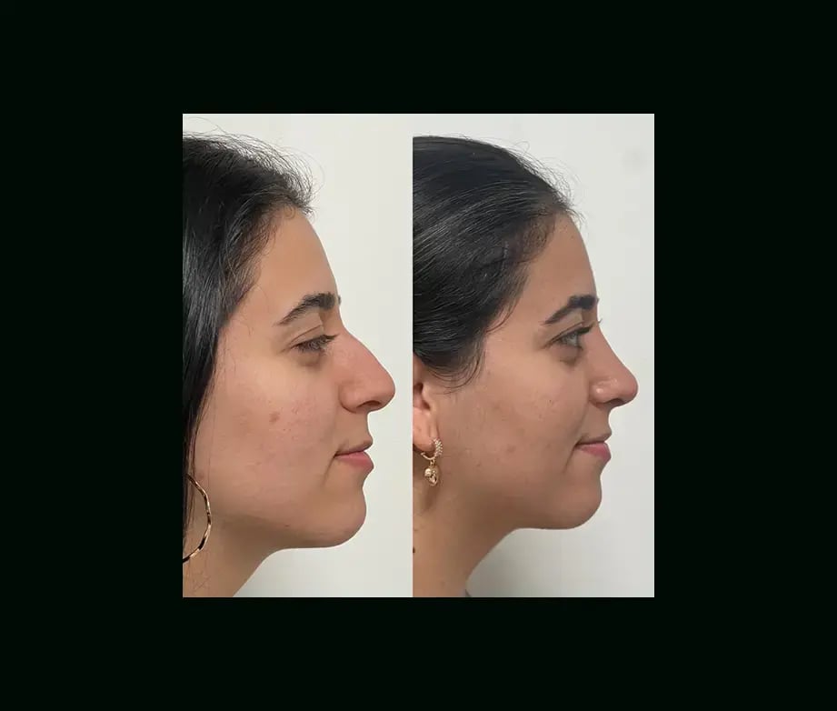 tayfun-demirel-md-rhinoplasty-before-after-23