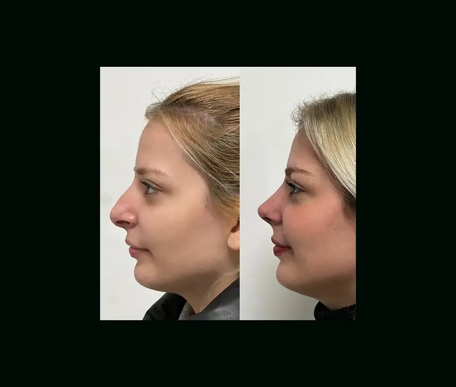 tayfun-demirel-md-rhinoplasty-before-after-24