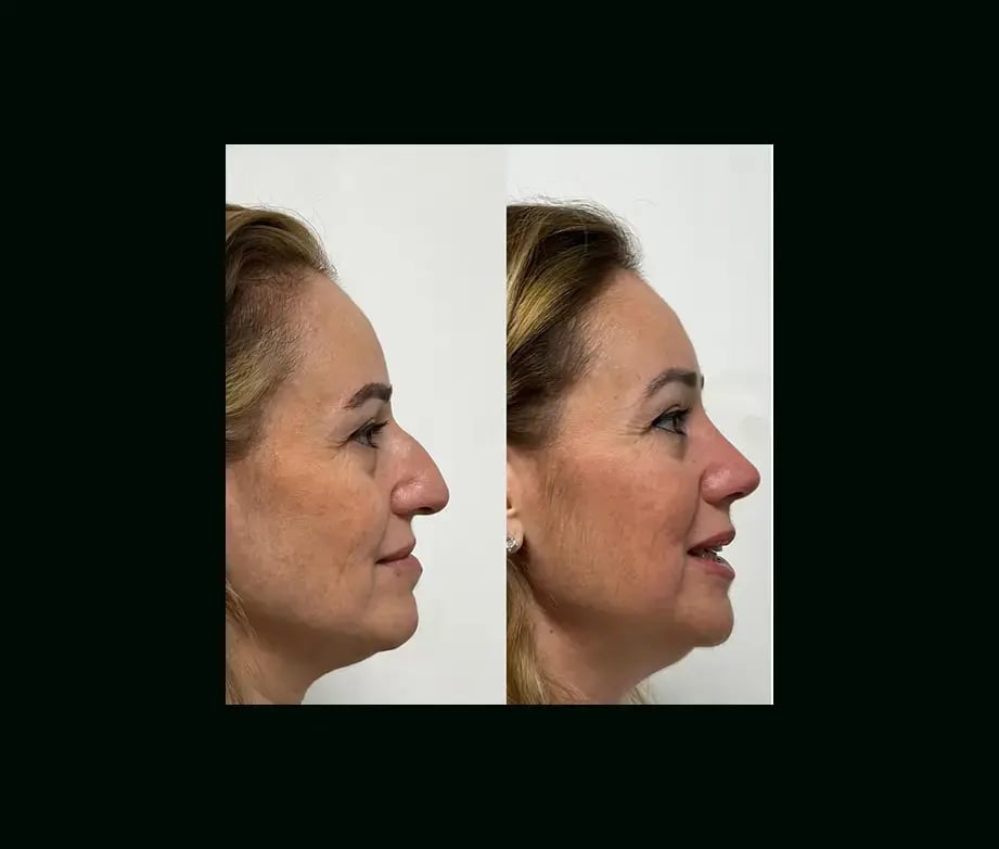 tayfun-demirel-md-rhinoplasty-before-after-25