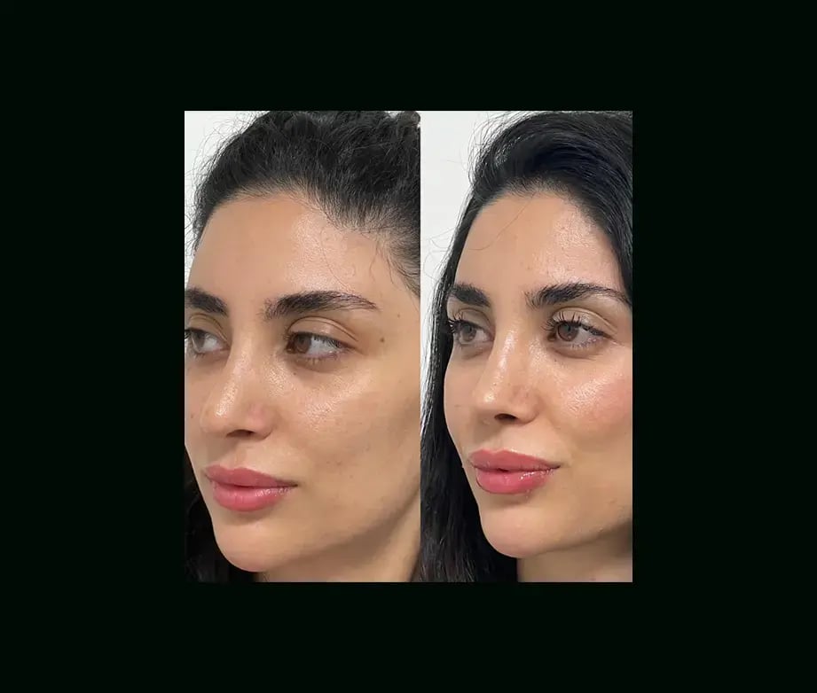 tayfun-demirel-md-rhinoplasty-before-after-26