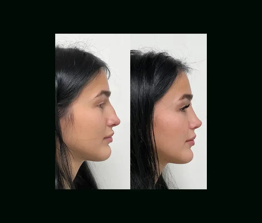 tayfun-demirel-md-rhinoplasty-before-after-27