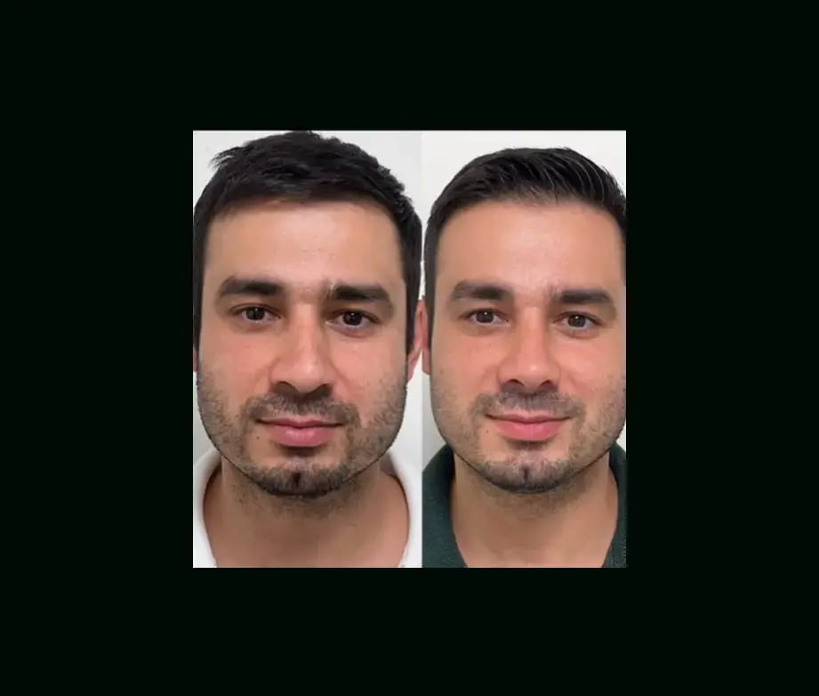 tayfun-demirel-md-rhinoplasty-before-after-28