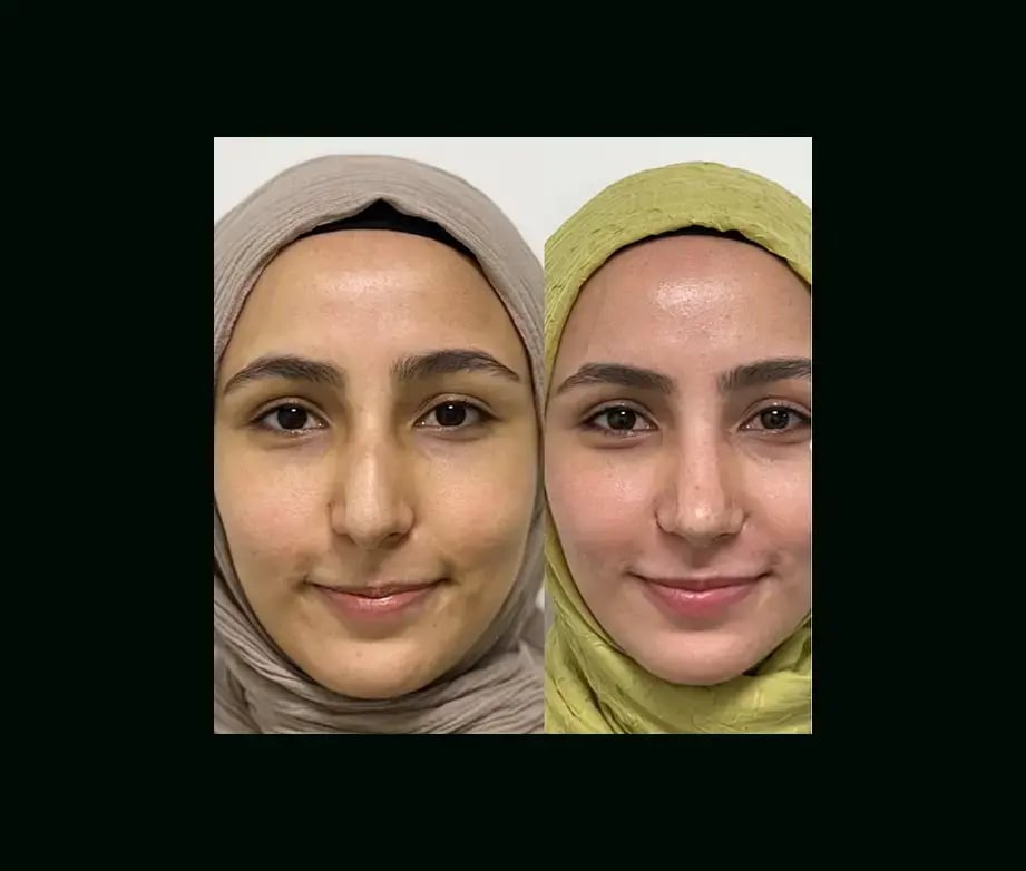 tayfun-demirel-md-rhinoplasty-before-after-29