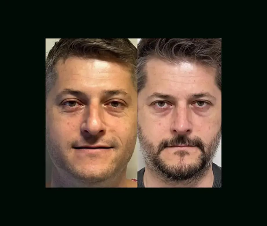 tayfun-demirel-md-rhinoplasty-before-after-3-1