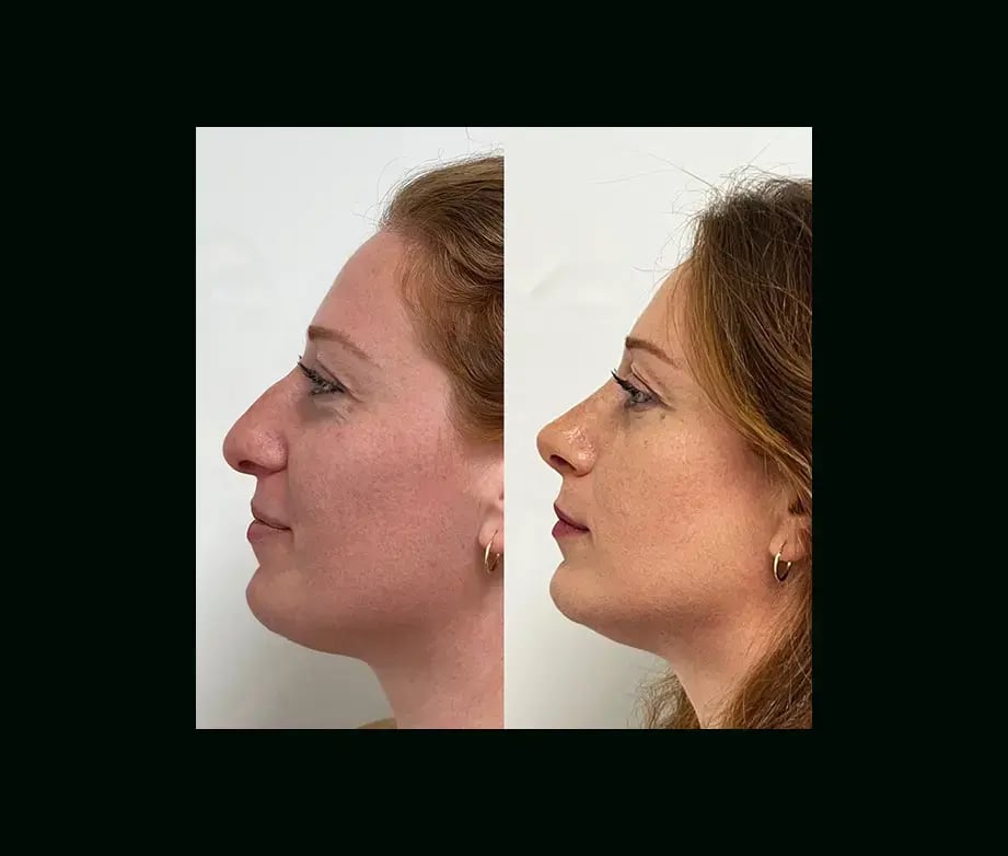 tayfun-demirel-md-rhinoplasty-before-after-30