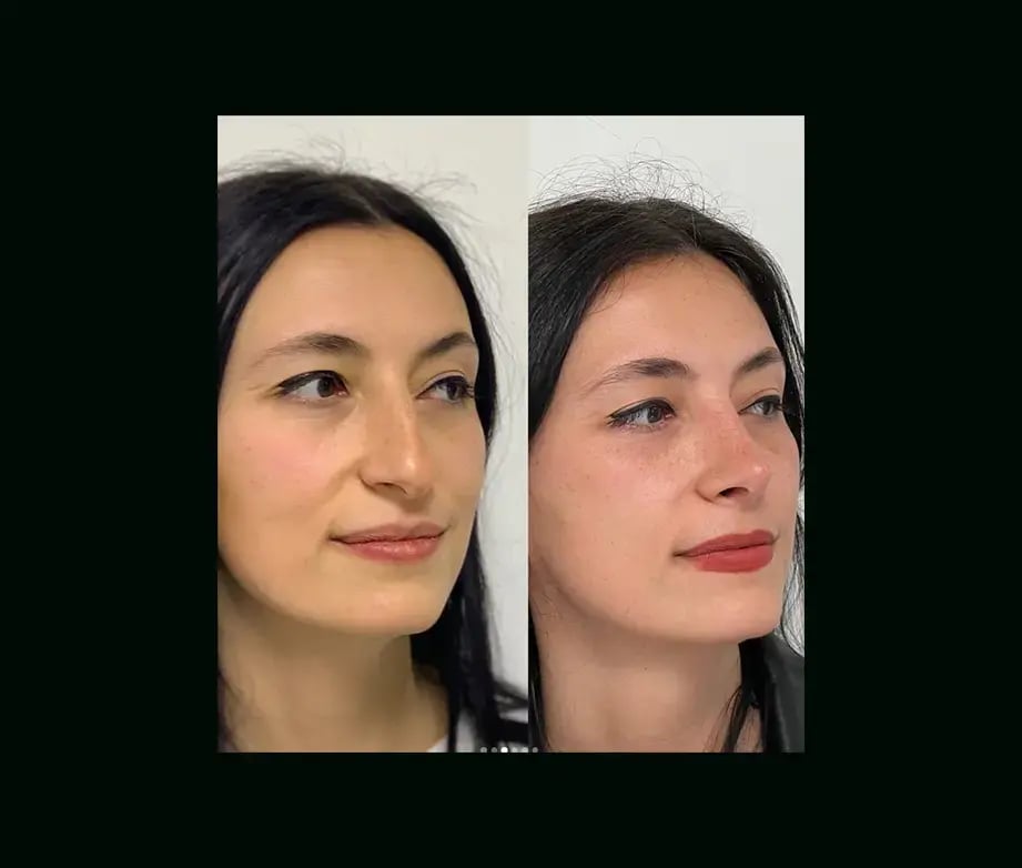 tayfun-demirel-md-rhinoplasty-before-after-31