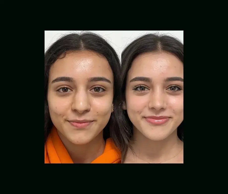 tayfun-demirel-md-rhinoplasty-before-after-32