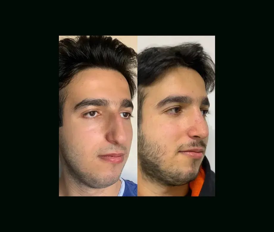 tayfun-demirel-md-rhinoplasty-before-after-33