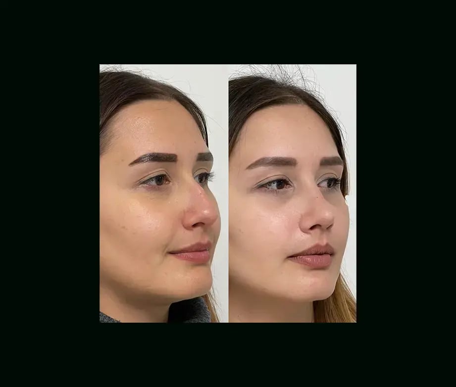 tayfun-demirel-md-rhinoplasty-before-after-34