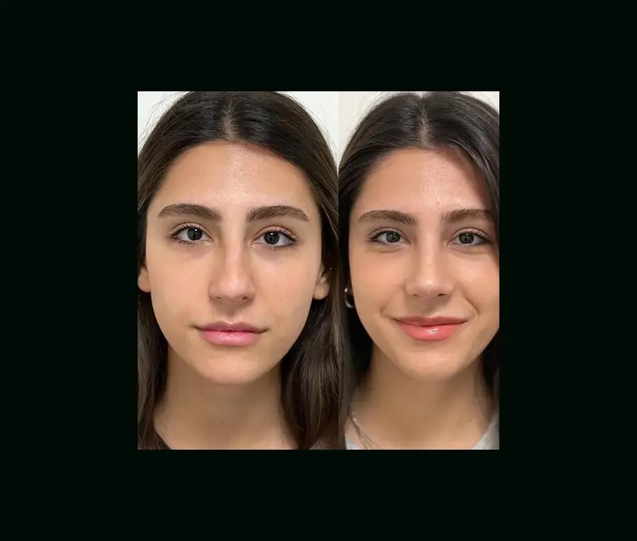 tayfun-demirel-md-rhinoplasty-before-after-35
