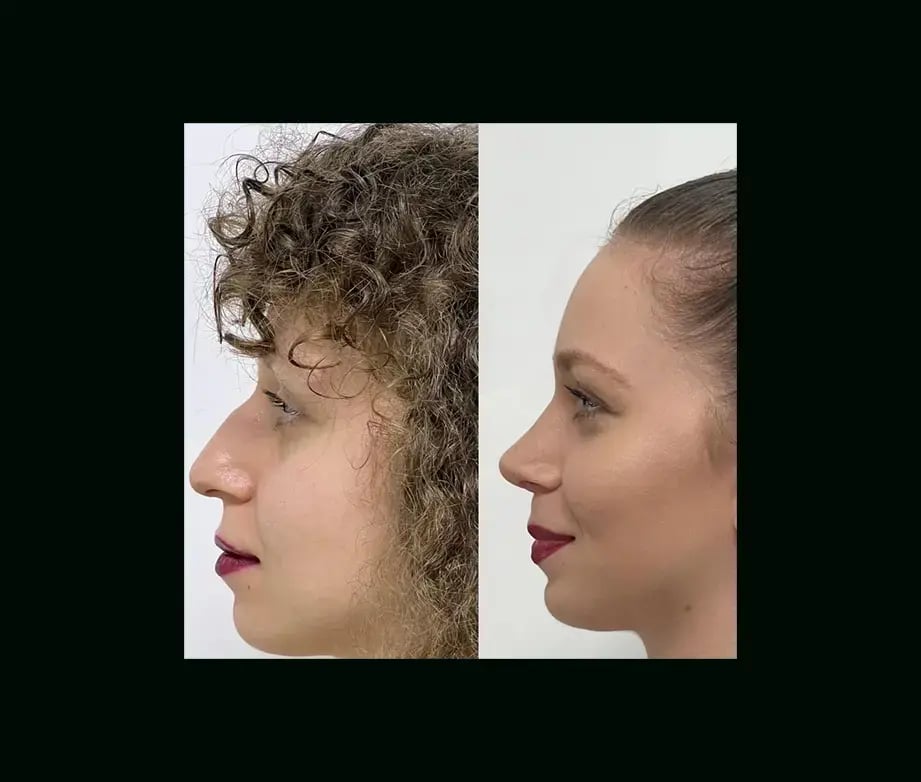 tayfun-demirel-md-rhinoplasty-before-after-36