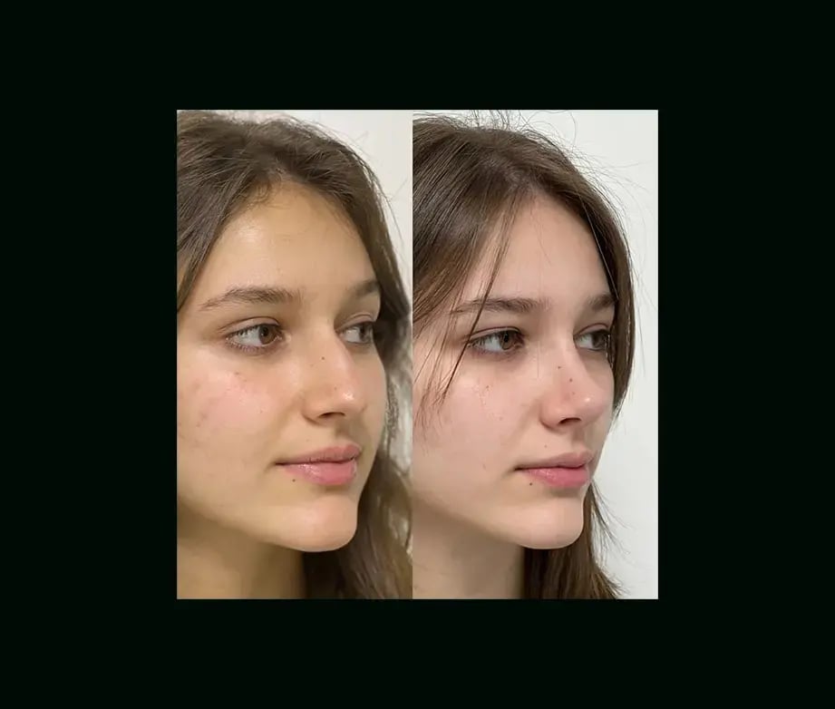 tayfun-demirel-md-rhinoplasty-before-after-37