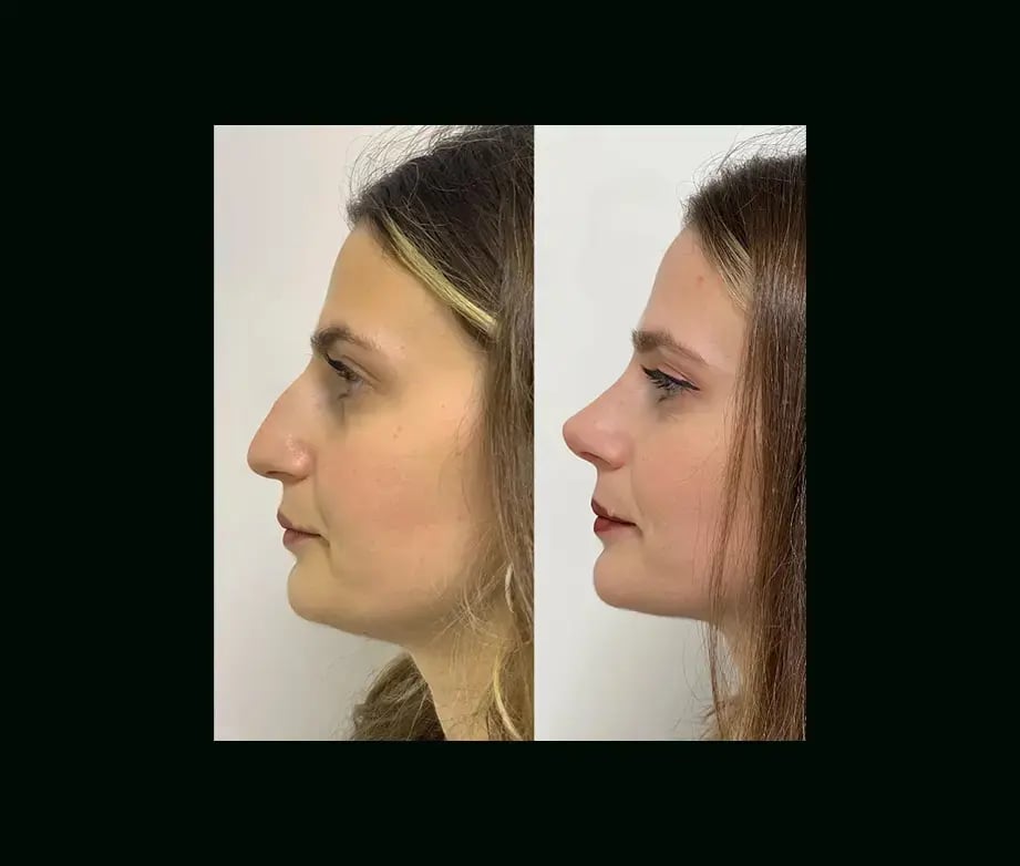 tayfun-demirel-md-rhinoplasty-before-after-38