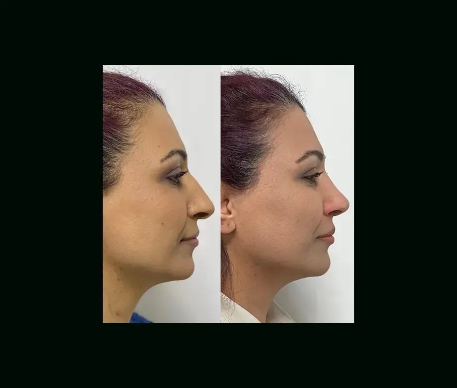 tayfun-demirel-md-rhinoplasty-before-after-39