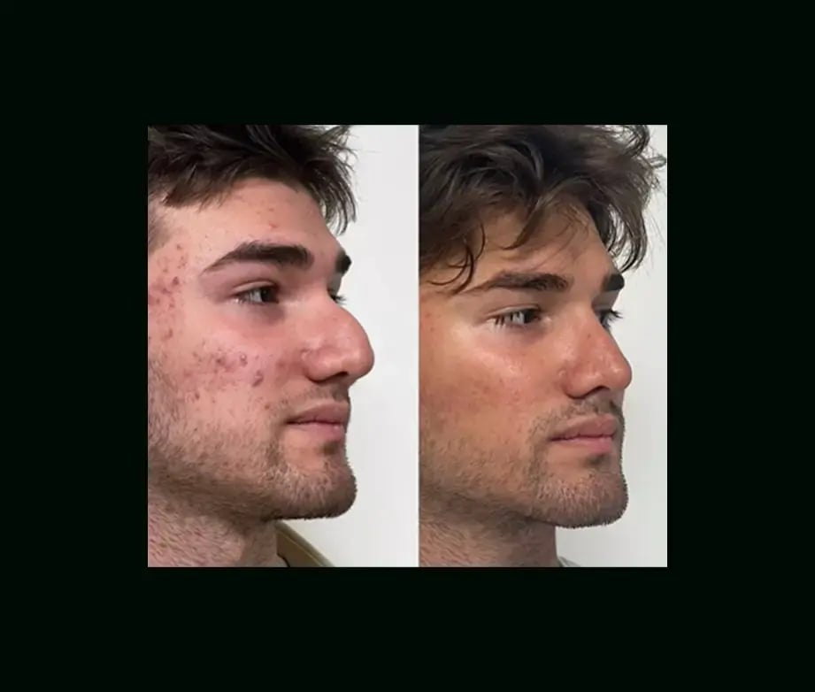 tayfun-demirel-md-rhinoplasty-before-after-4-1