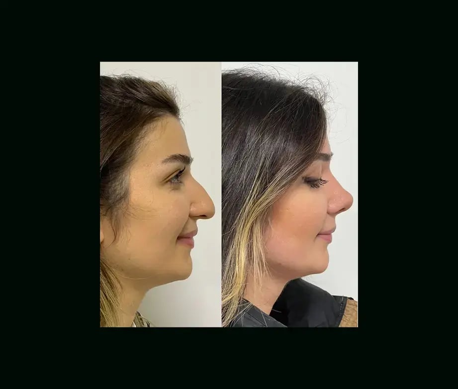 tayfun-demirel-md-rhinoplasty-before-after-40
