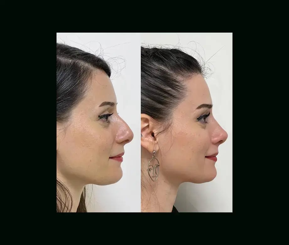 tayfun-demirel-md-rhinoplasty-before-after-41