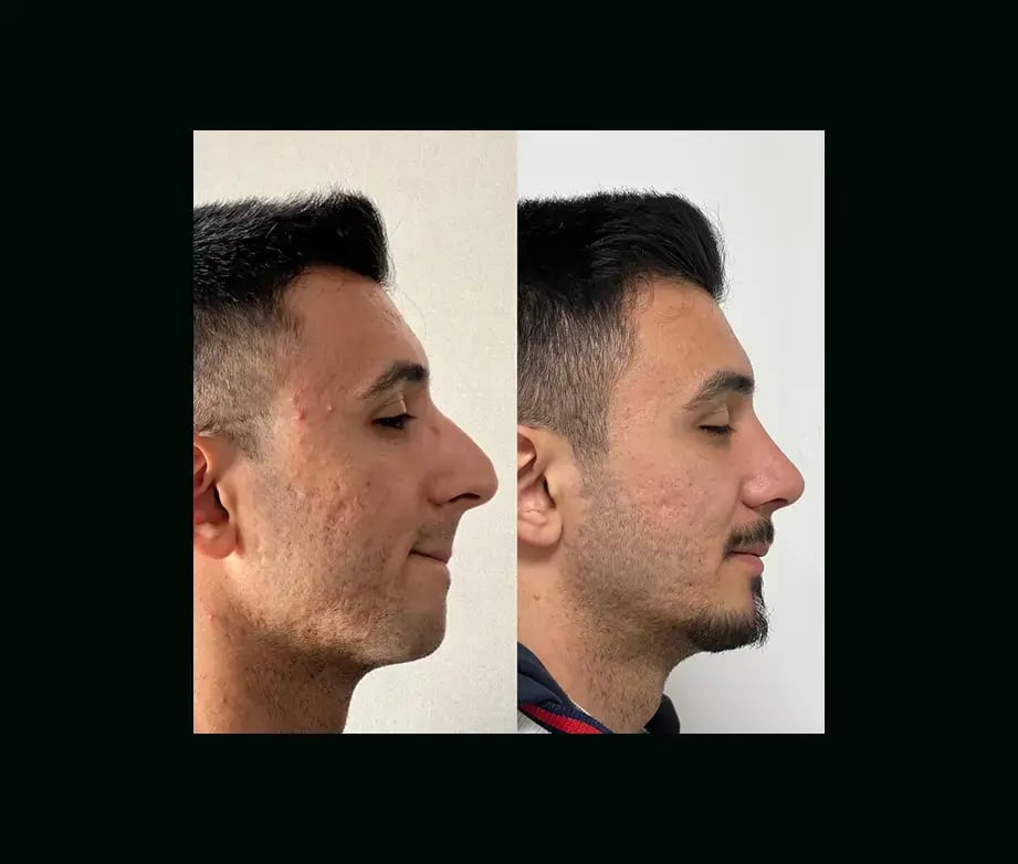 tayfun-demirel-md-rhinoplasty-before-after-42
