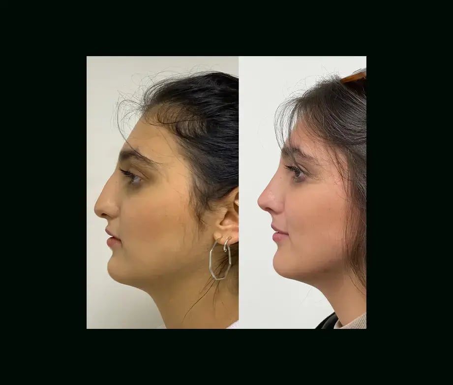 tayfun-demirel-md-rhinoplasty-before-after-43