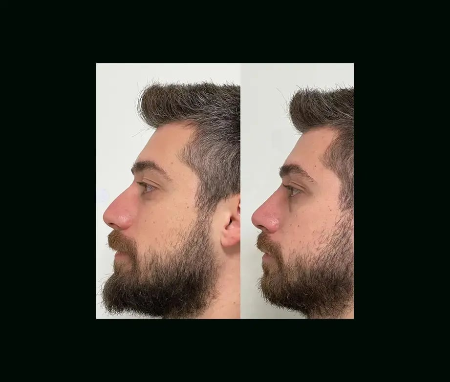 tayfun-demirel-md-rhinoplasty-before-after-44