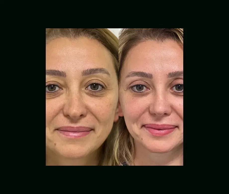 tayfun-demirel-md-rhinoplasty-before-after-45