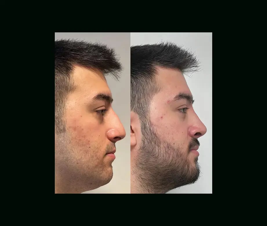 tayfun-demirel-md-rhinoplasty-before-after-46