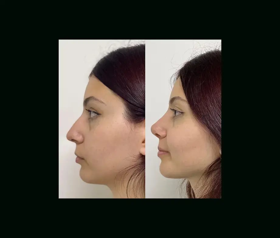 tayfun-demirel-md-rhinoplasty-before-after-48