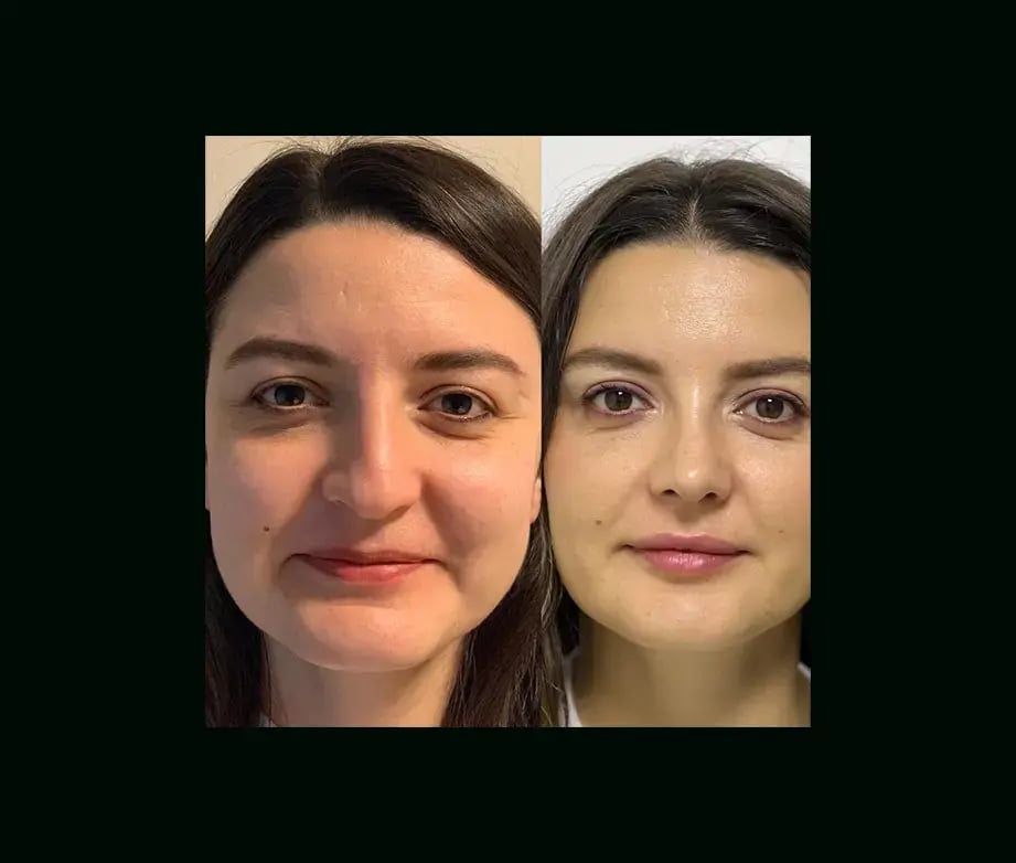 tayfun-demirel-md-rhinoplasty-before-after-49