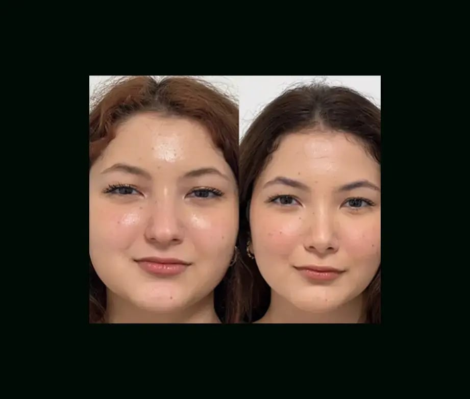 tayfun-demirel-md-rhinoplasty-before-after-5-1