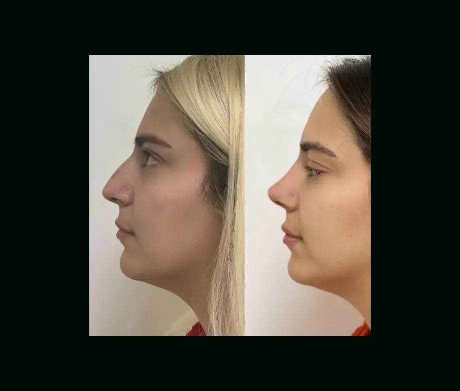 tayfun-demirel-md-rhinoplasty-before-after-50