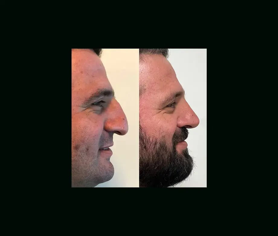 tayfun-demirel-md-rhinoplasty-before-after-6