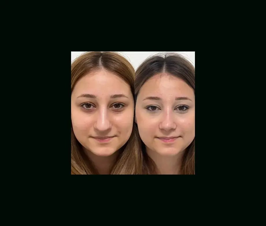 tayfun-demirel-md-rhinoplasty-before-after-7