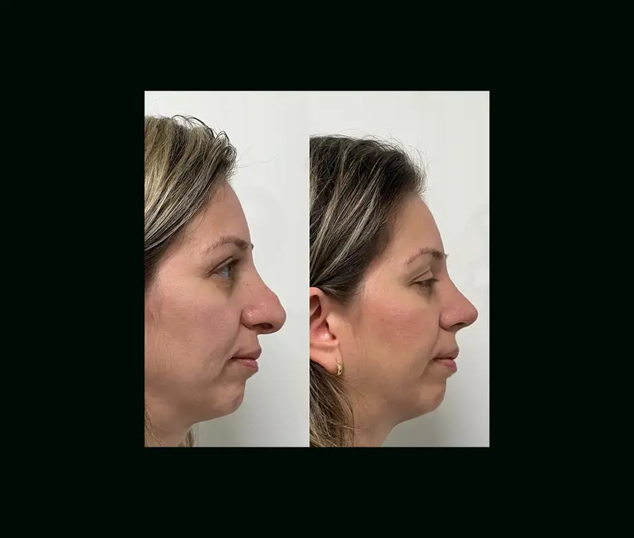 tayfun-demirel-md-rhinoplasty-before-after-8