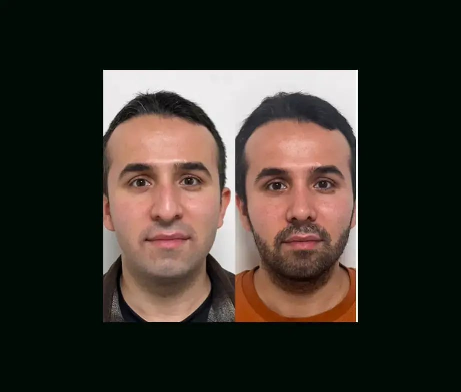 tayfun-demirel-md-rhinoplasty-before-after-9