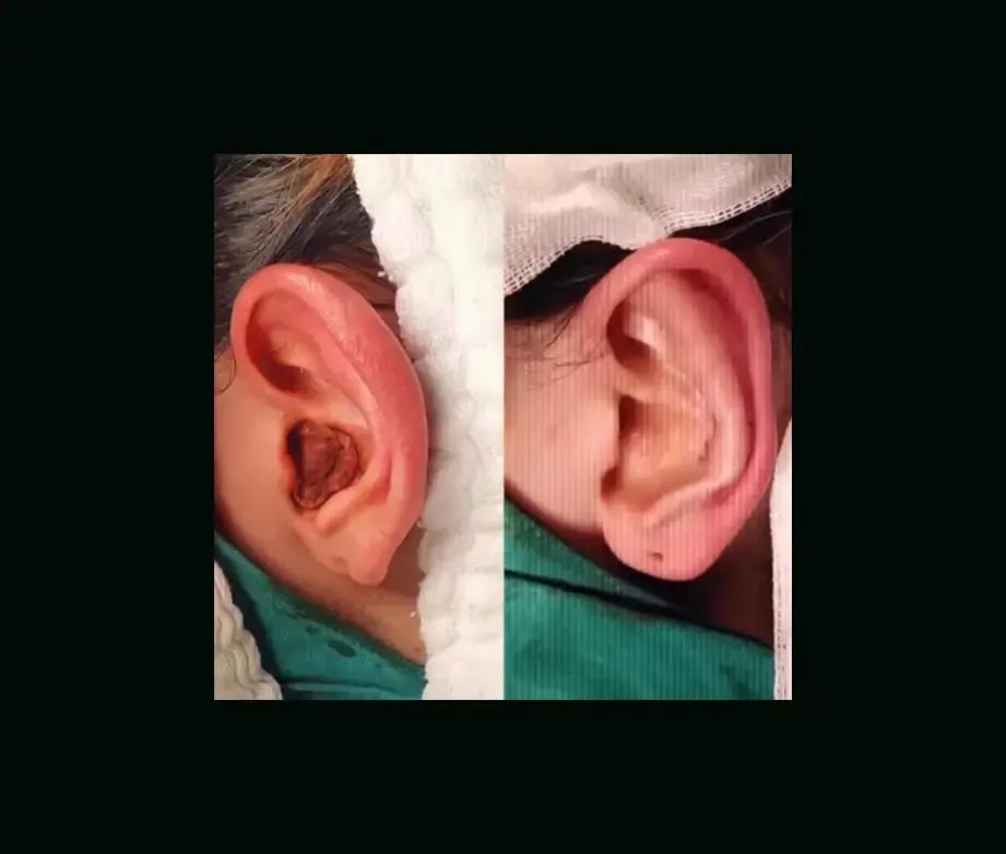 tugce-simsek-md-ear-surgery-before-after-1
