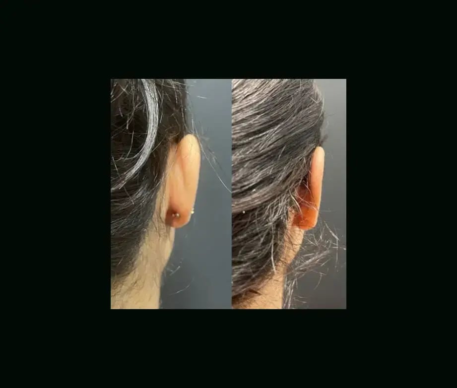 tugce-simsek-md-ear-surgery-before-after-11-1