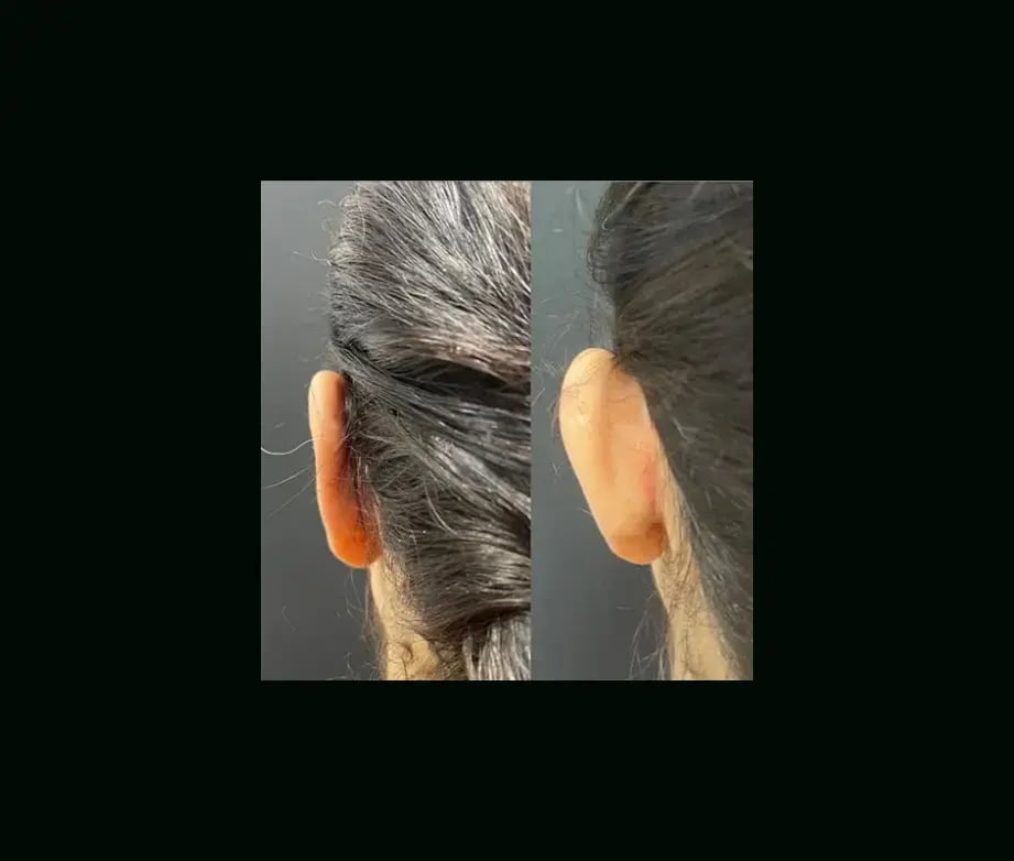 tugce-simsek-md-ear-surgery-before-after-12