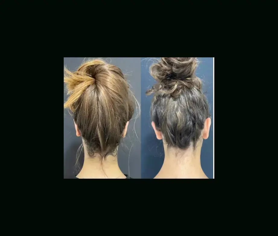 tugce-simsek-md-ear-surgery-before-after-13