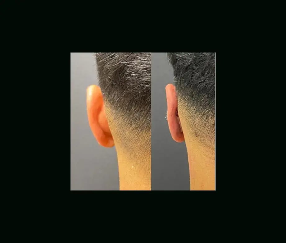 tugce-simsek-md-ear-surgery-before-after-14